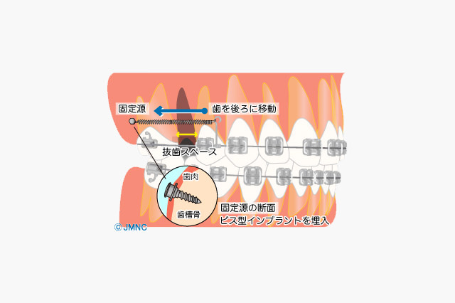 インプラント矯正